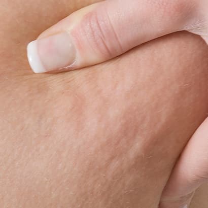 Hroniska vēnu mazspēja