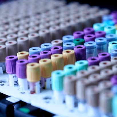 Pandēmijā pasliktinājušies iedzīvotāju analīžu rādītāji: kādas ir ieteicamās veselības pārbaudes laboratorijā un mājas apstākļos?