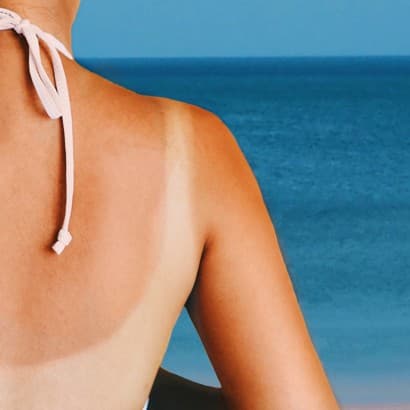 Starp dzīvību un nāvi jeb melanoma