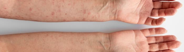 5 ādas iekaisumu veidi vasarā – kā tos novērst? Skaidro farmaceits