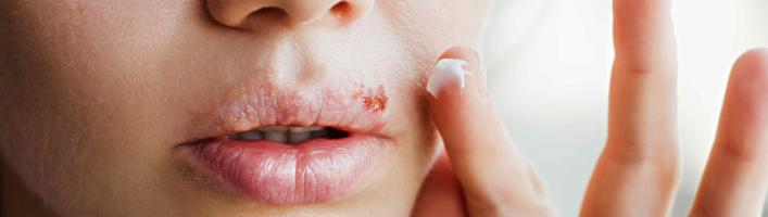 Снова беспокоит и болит! Советы фармацевта по борьбе с простудой на губах
