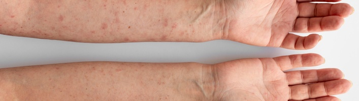 5 видов воспалений кожи летом – как их предотвратить? Объясняет фармацевт