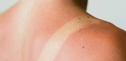 Когда солнца слишком много – советы, что делать, если кожа обгорела