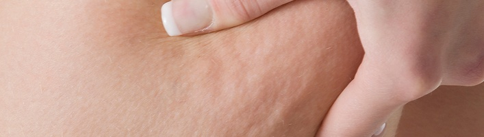 Hroniska vēnu mazspēja