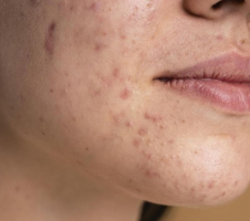 Как летом предотвратить разные проблемы с кожей и самочувствием?